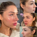 FACIAL BALANCING $15,000