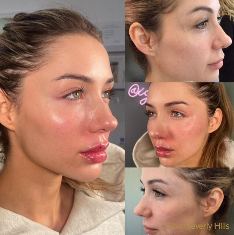FACIAL BALANCING $9,200